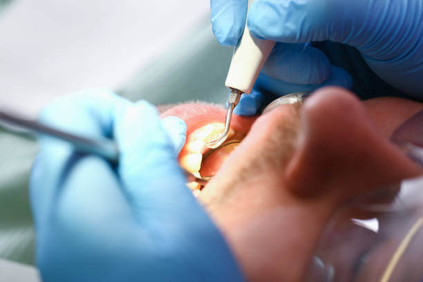 Best Emergency Tooth Extraction in Swainsboro, GA