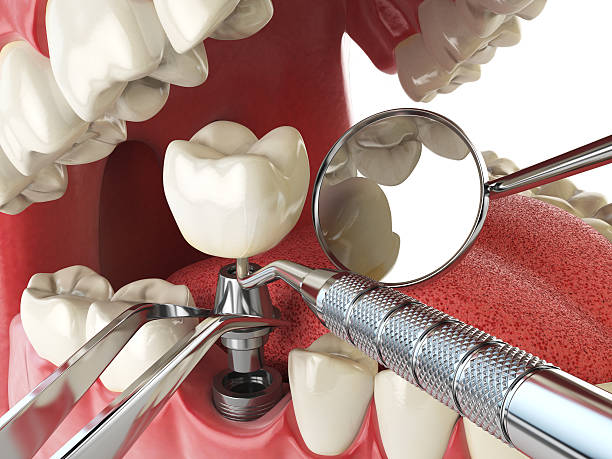 Best Emergency Wisdom Teeth Removal in Swainsboro, GA